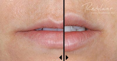 Restylane-Cost-before-and-after-photos