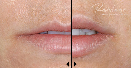Restylane-Cost-before-and-after-photos