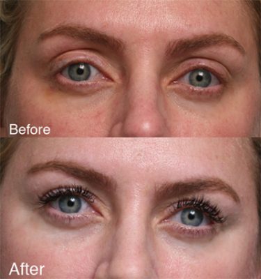 Revising Upper Eyelid Surgery