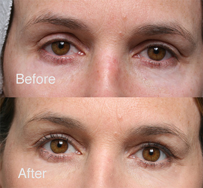 Revising Upper Eyelid Surgery