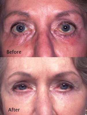 Revision Eyelid Surgery