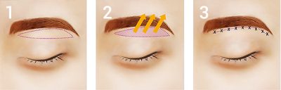 Sub-brow blepharoplasty