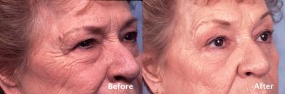 Upper Eyelid Surgery