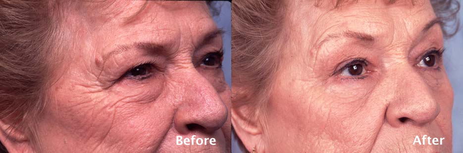 Upper Eyelid Surgery