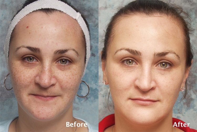 Revison Eyelid surgery (blepharoplasty) Before & After Photos