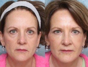 Revison Eyelid surgery (blepharoplasty) Before & After Photos