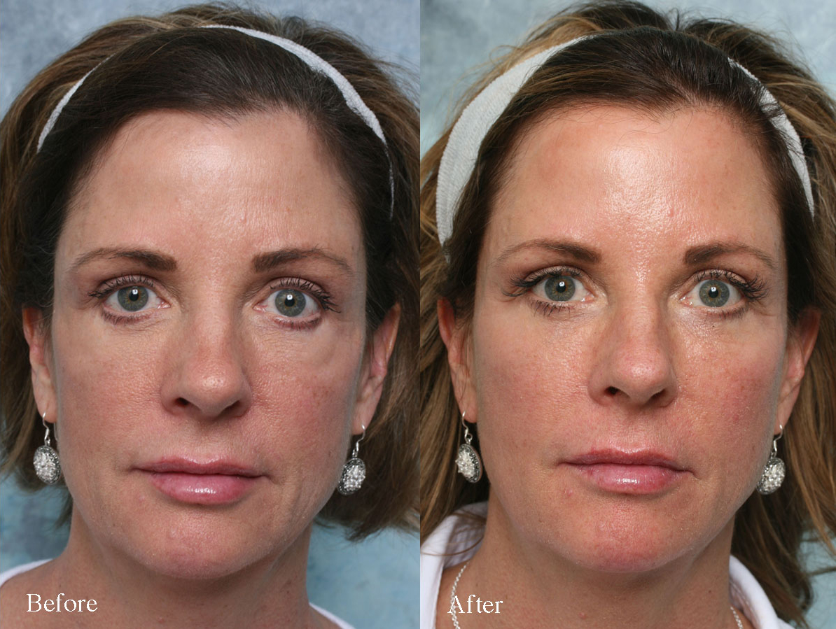 Before After
