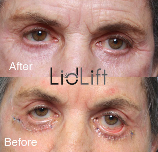 Before After