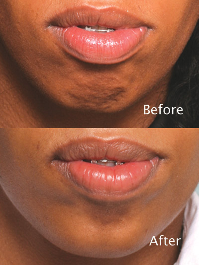 Procedure: Chin BOTOX®