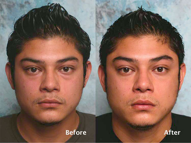 Procedure: Blepharoplasty for Men Case 2