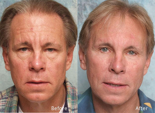 Procedure: Blepharoplasty for Men Case 3