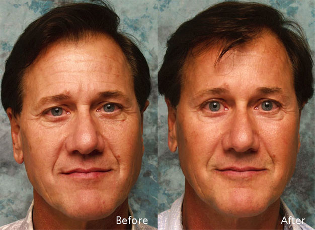 Procedure: Blepharoplasty for Men Case 5
