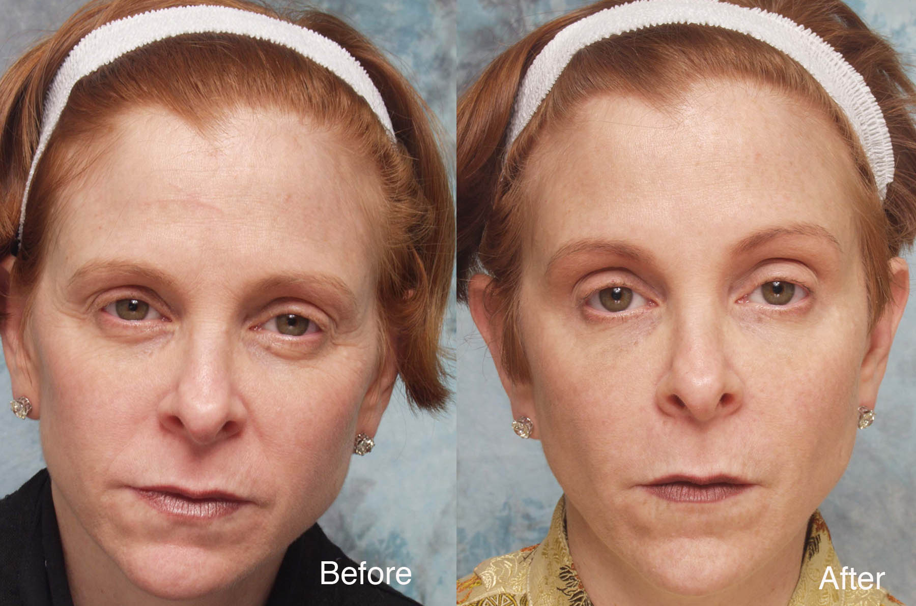 Procedure: Microdroplet Lift® BOTOX® and Deepfill™ Restylane®