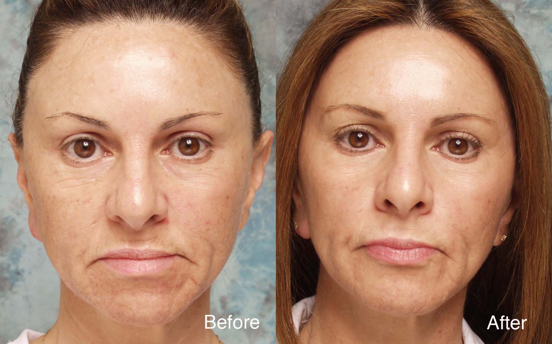 Procedure: Microdroplet Lift® BOTOX® and Fotofacial®