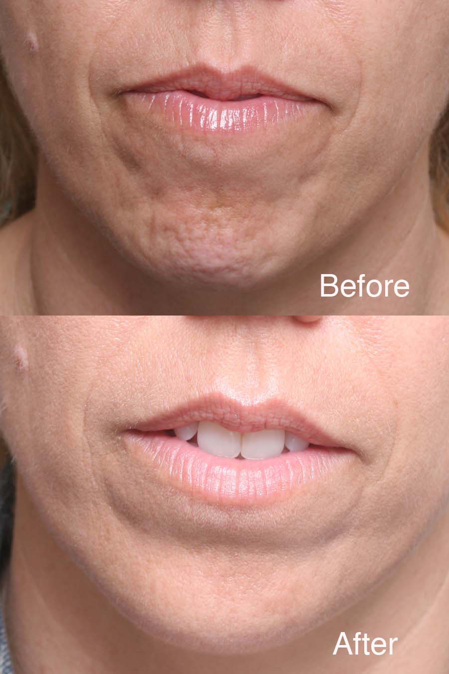 Procedure: Chin BOTOX®