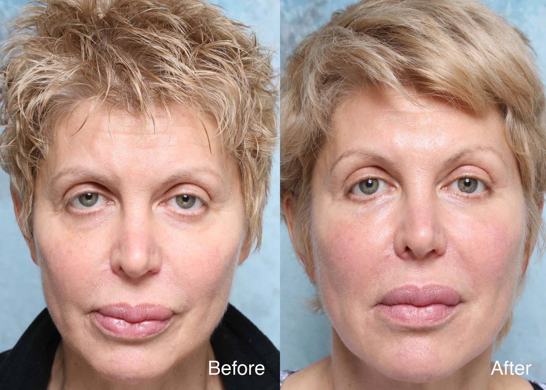 Procedure: Microdroplet Lift® BOTOX® and Under Eye Restylane®