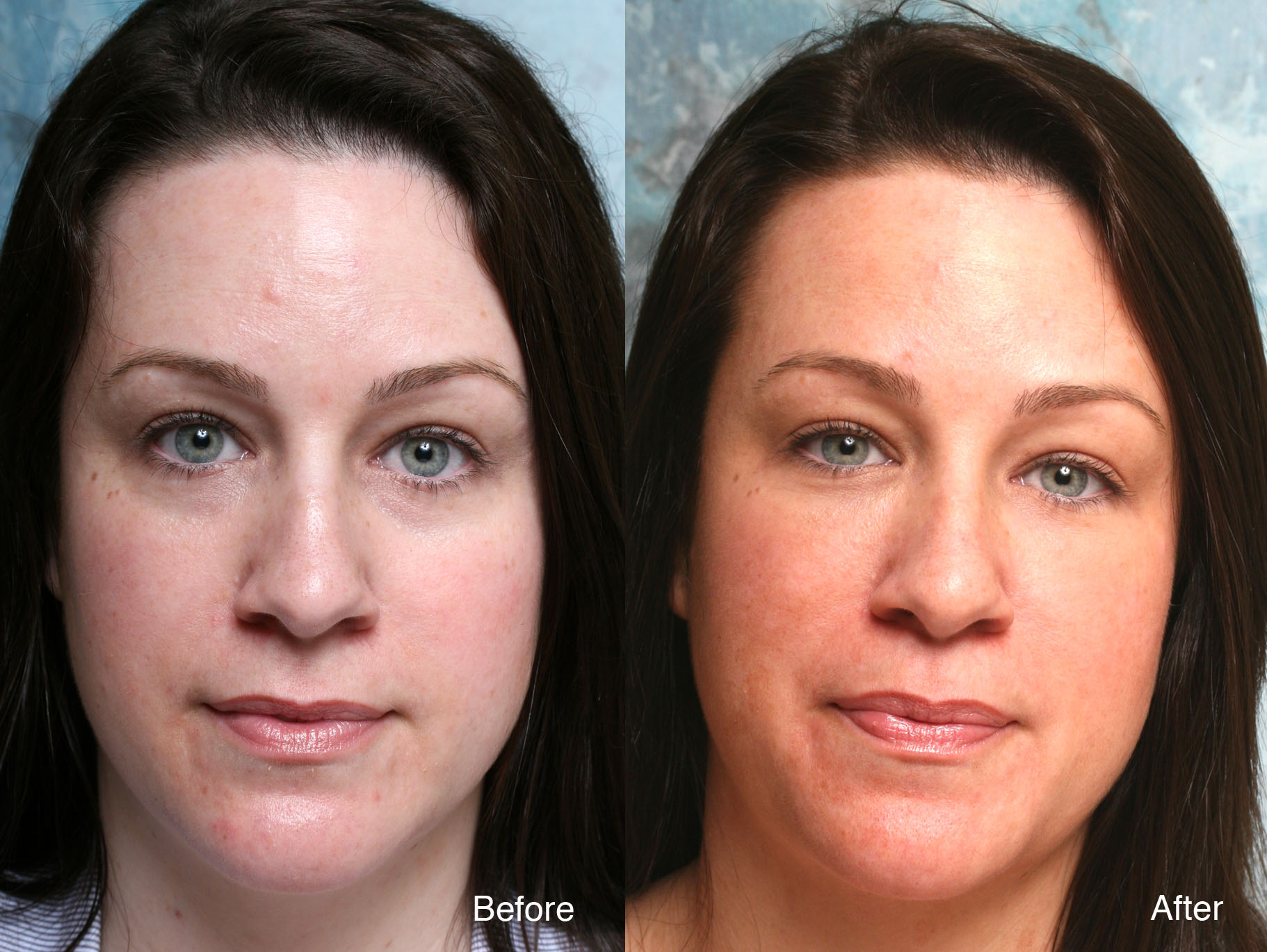 Procedure: Microdroplet Lift® BOTOX® and Under Eye Restylane®