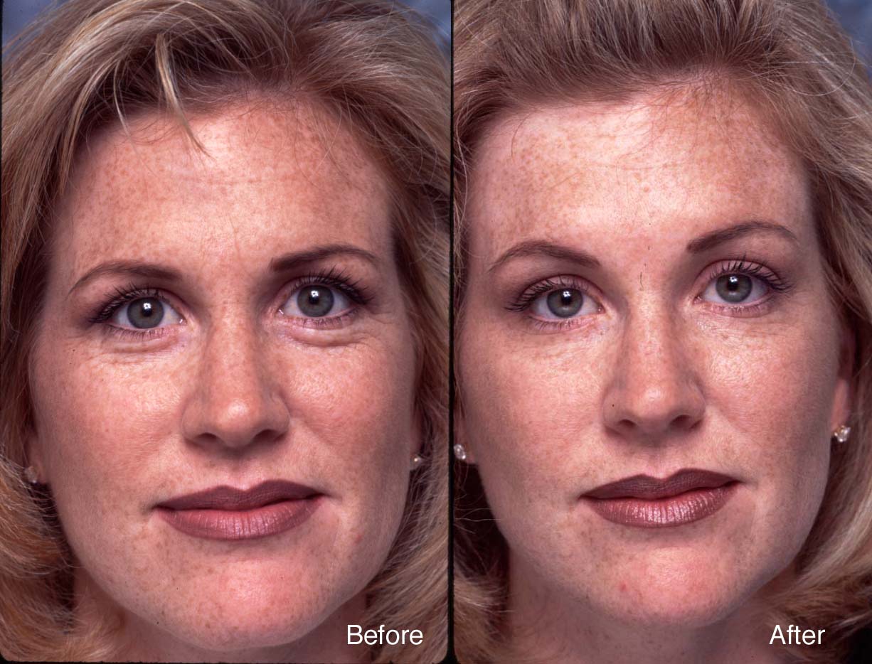 Procedure: Microdroplet Lift® BOTOX®