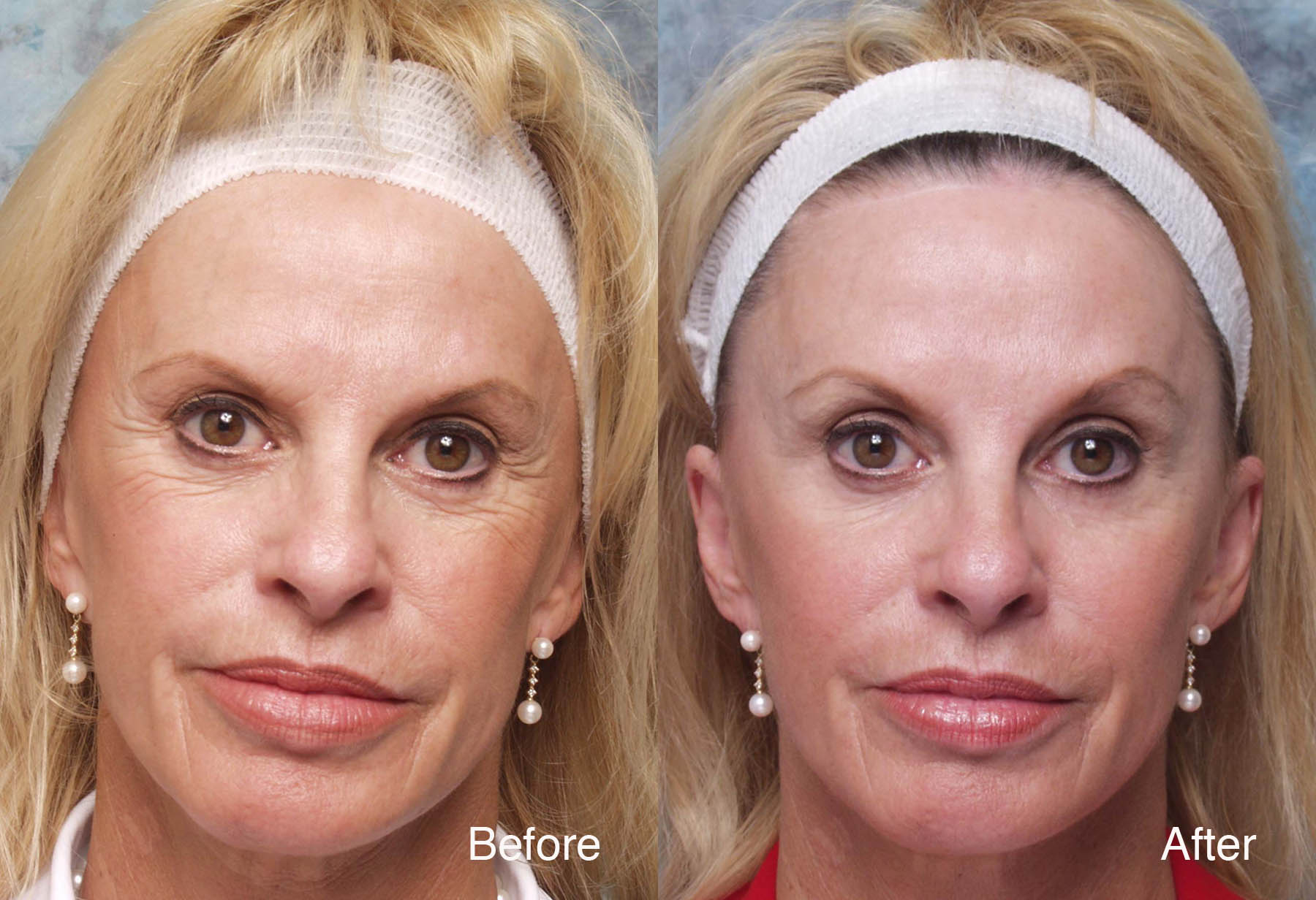 Procedure: Microdroplet Lift® BOTOX® Forehead Lift