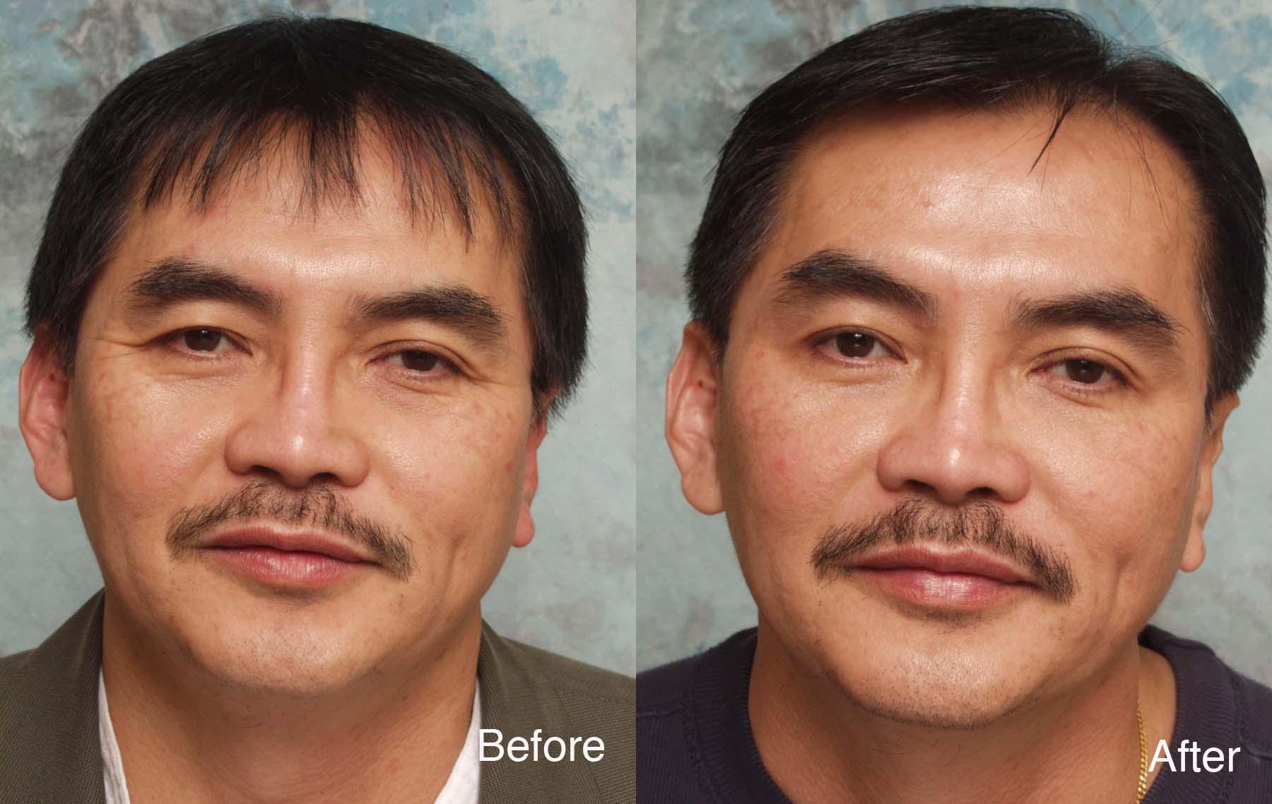 Procedure: Microdroplet Lift® BOTOX® and Deepfill™ Restylane®