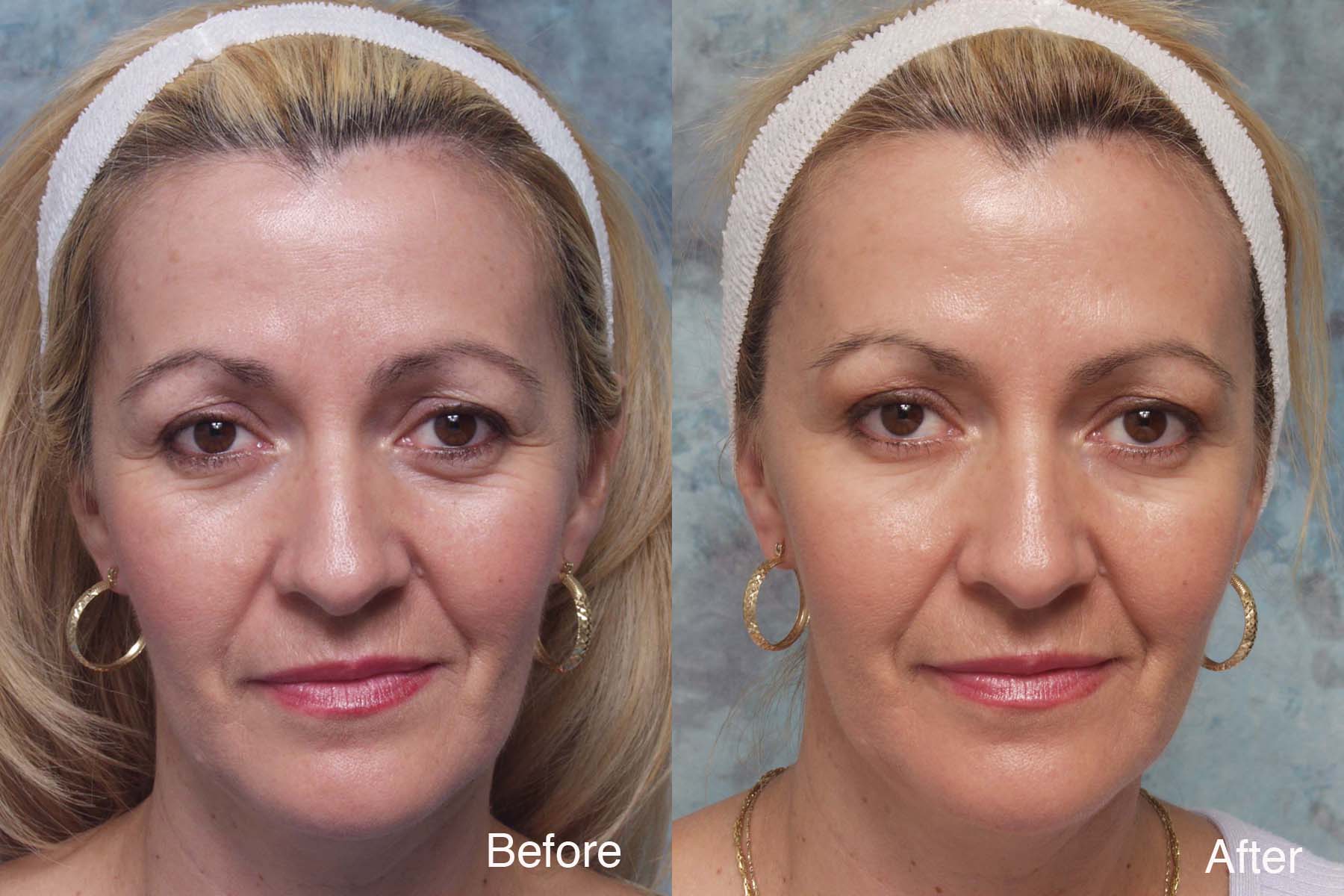 Procedure: Microdroplet Lift® BOTOX®