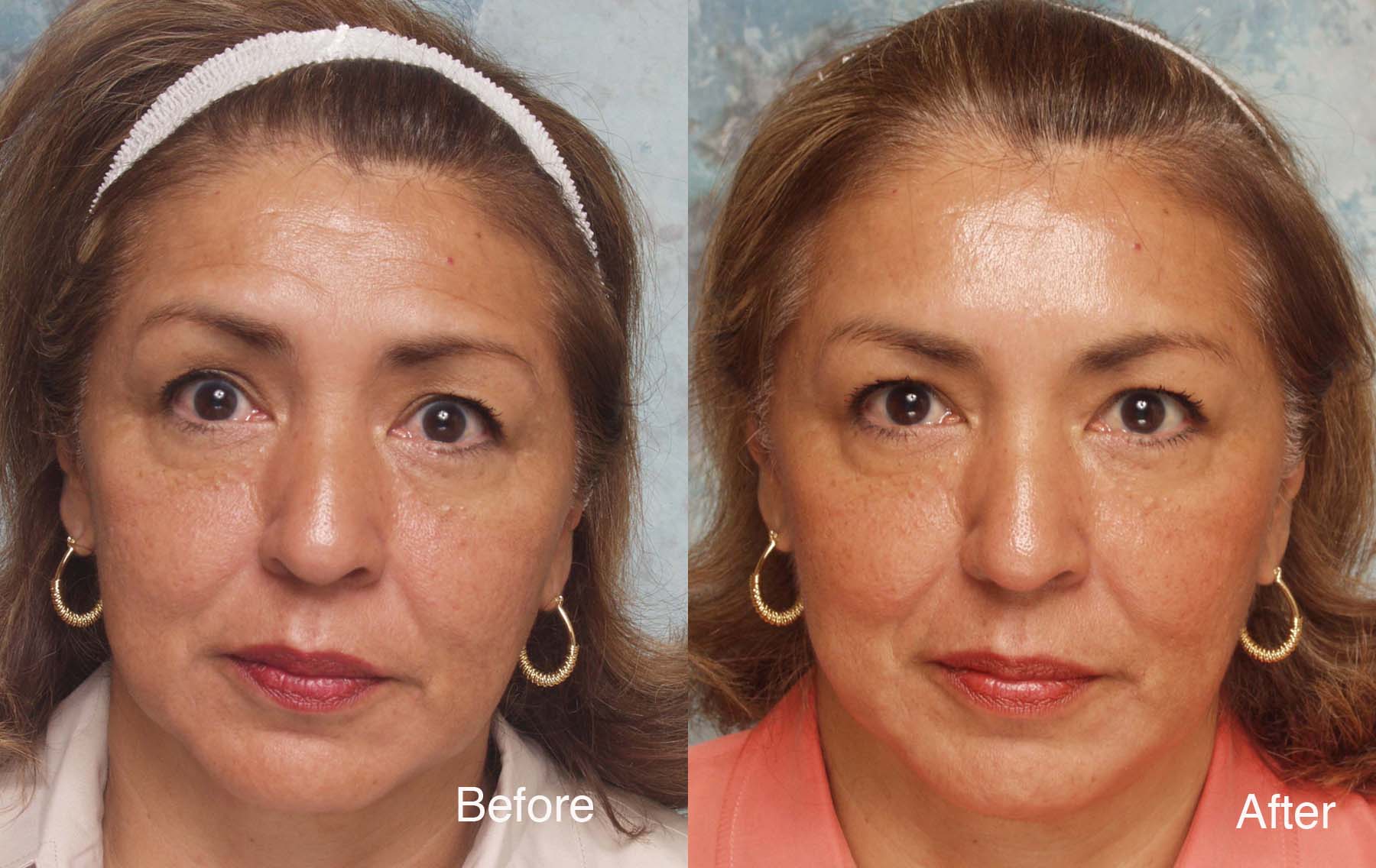 Procedure: Microdroplet Lift® BOTOX®