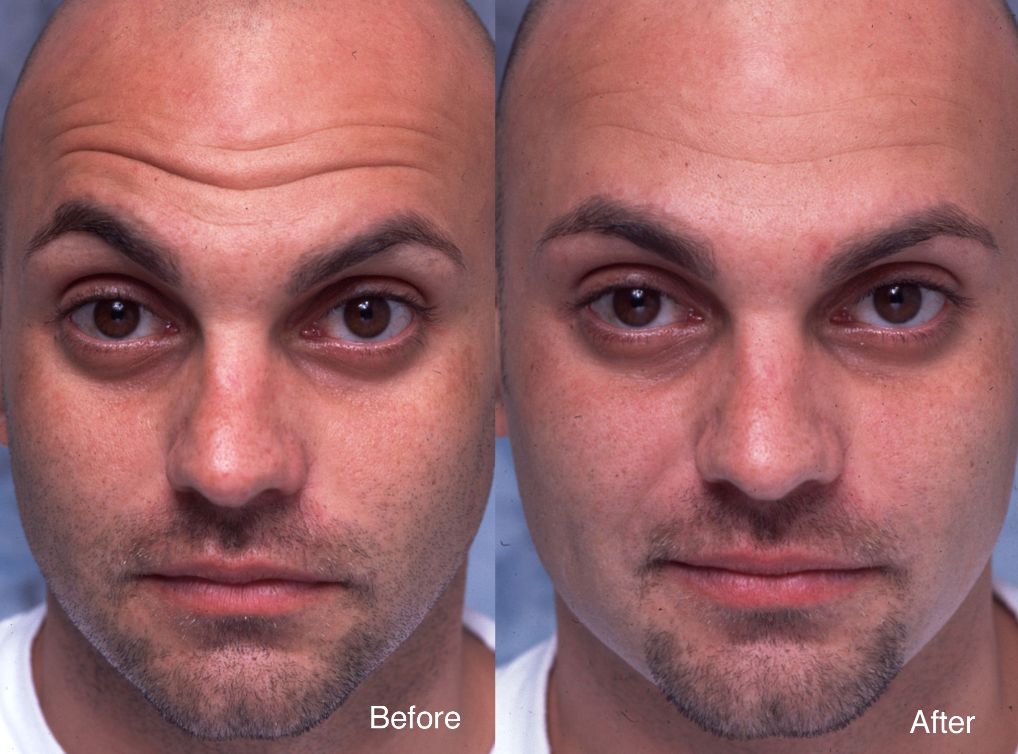 Procedure: Microdroplet Lift® BOTOX®