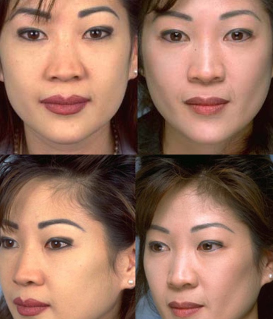 Procedure: Buccal Fat Surgery