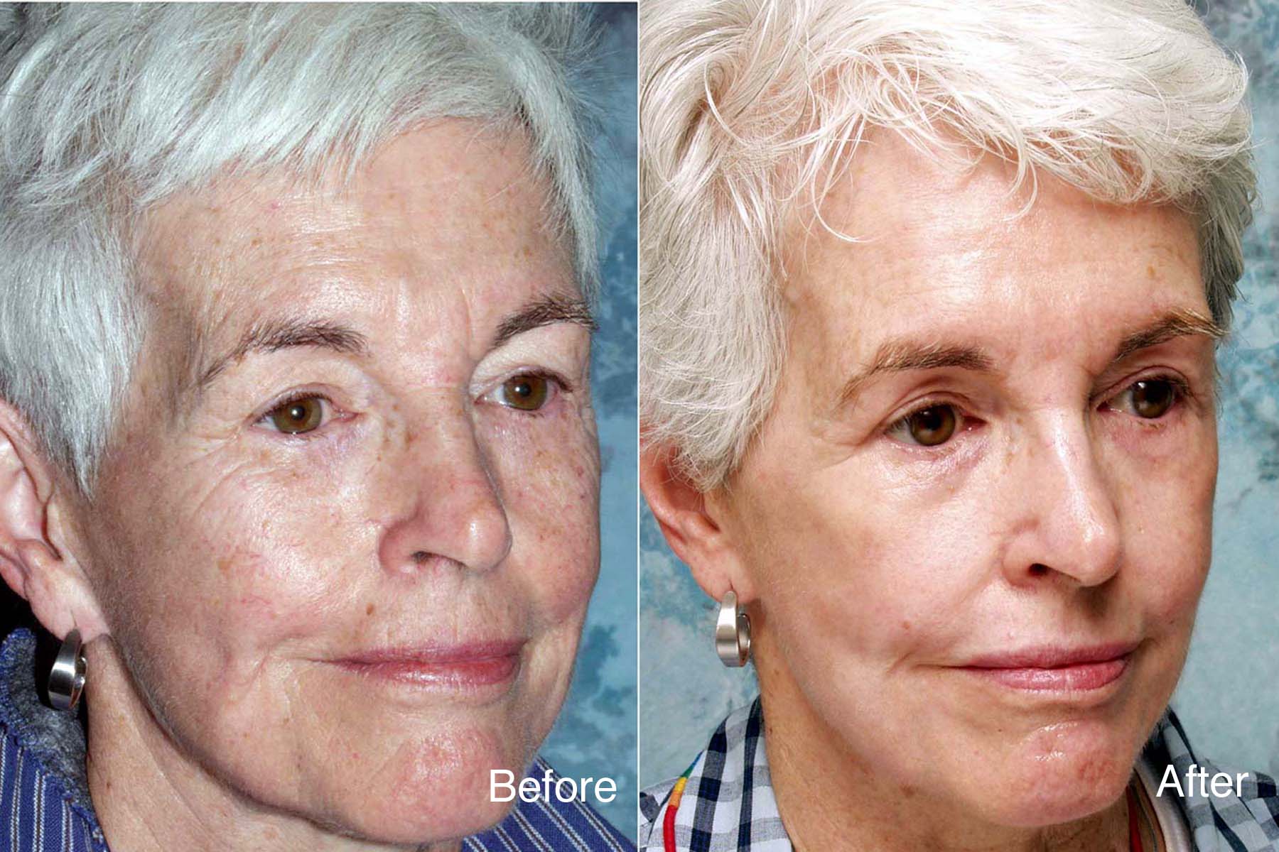 Procedure: Full Face Chemical Peel