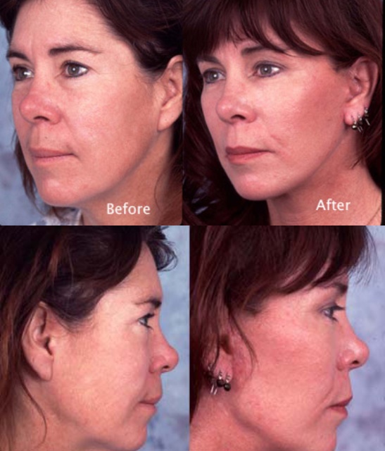 Procedure: Face Lift