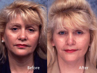 Procedure: Cosmetic Facial Surgery