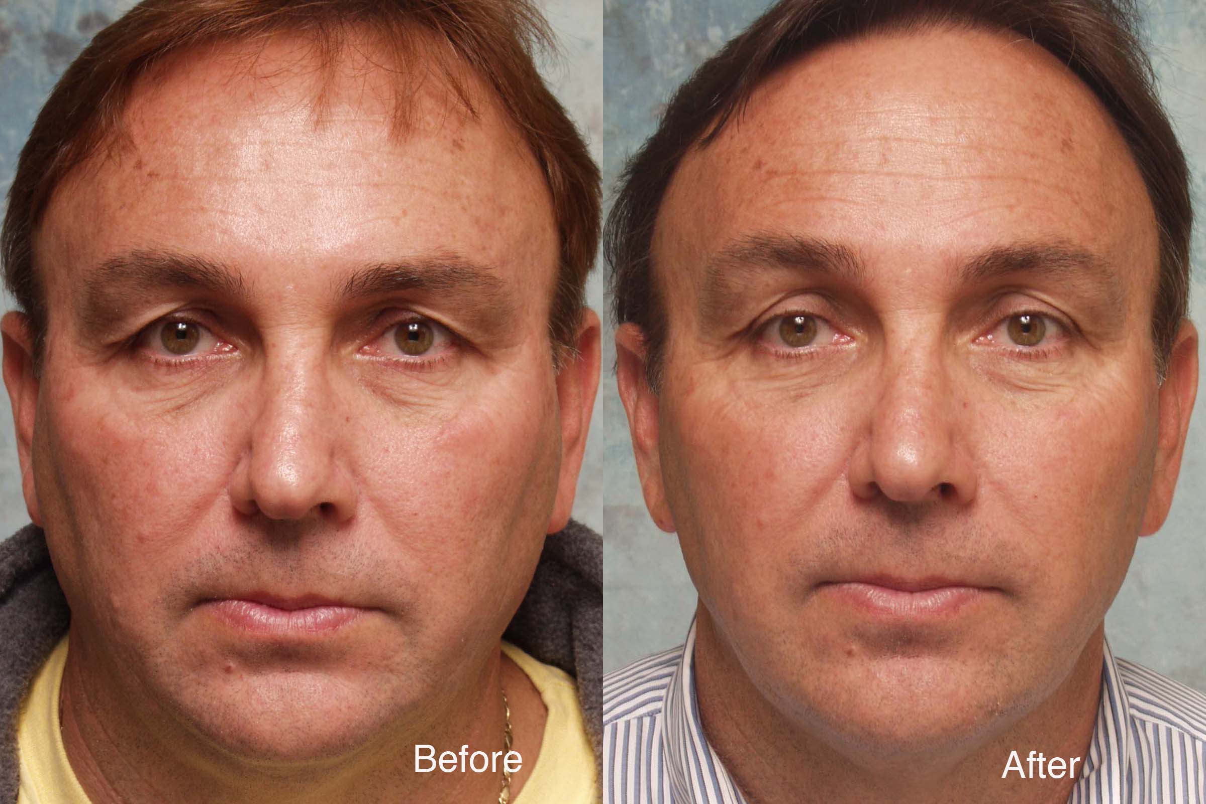 Procedure: Facial Rejuvenation