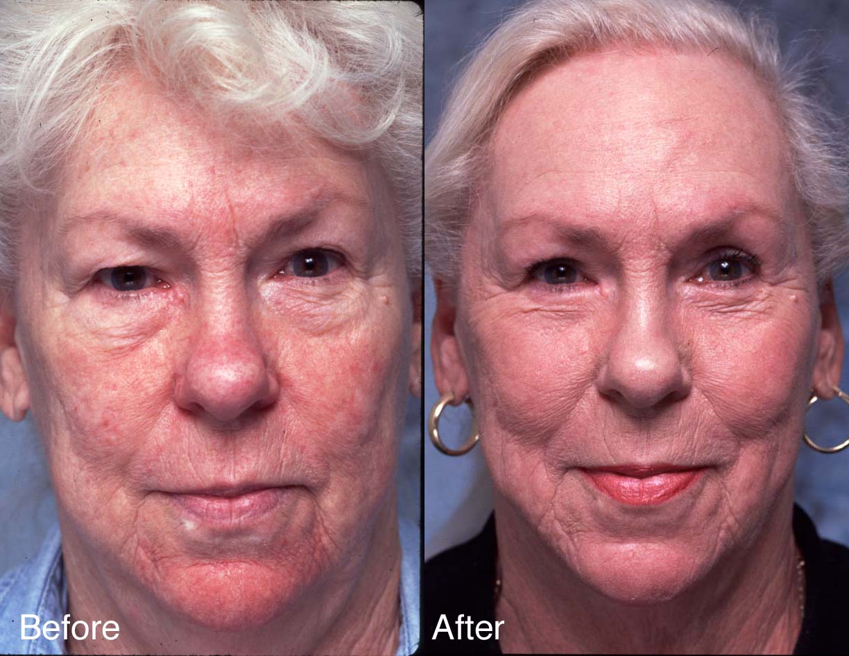 Procedure: Facial Rejuvenation