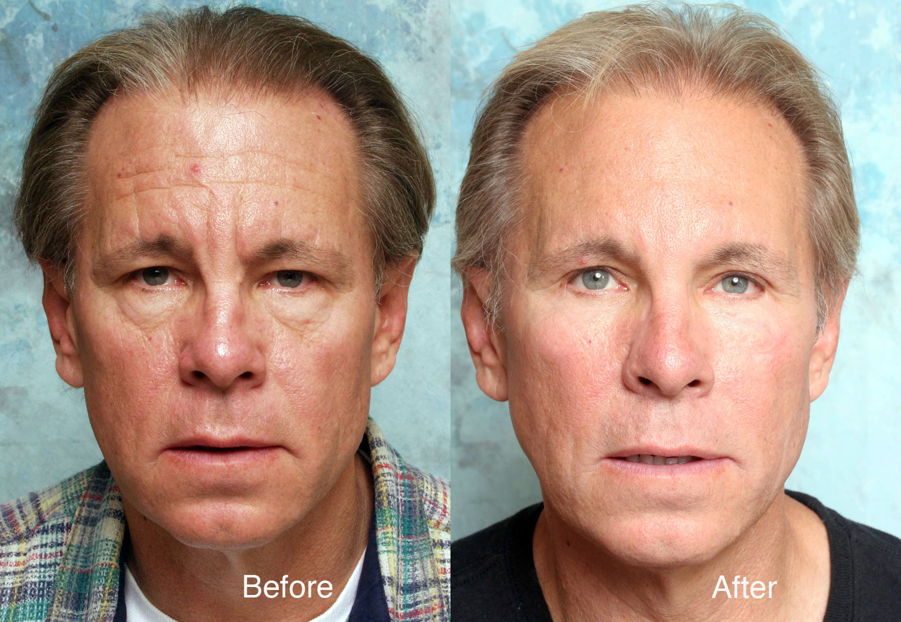 Procedure: Facial Rejuvenation