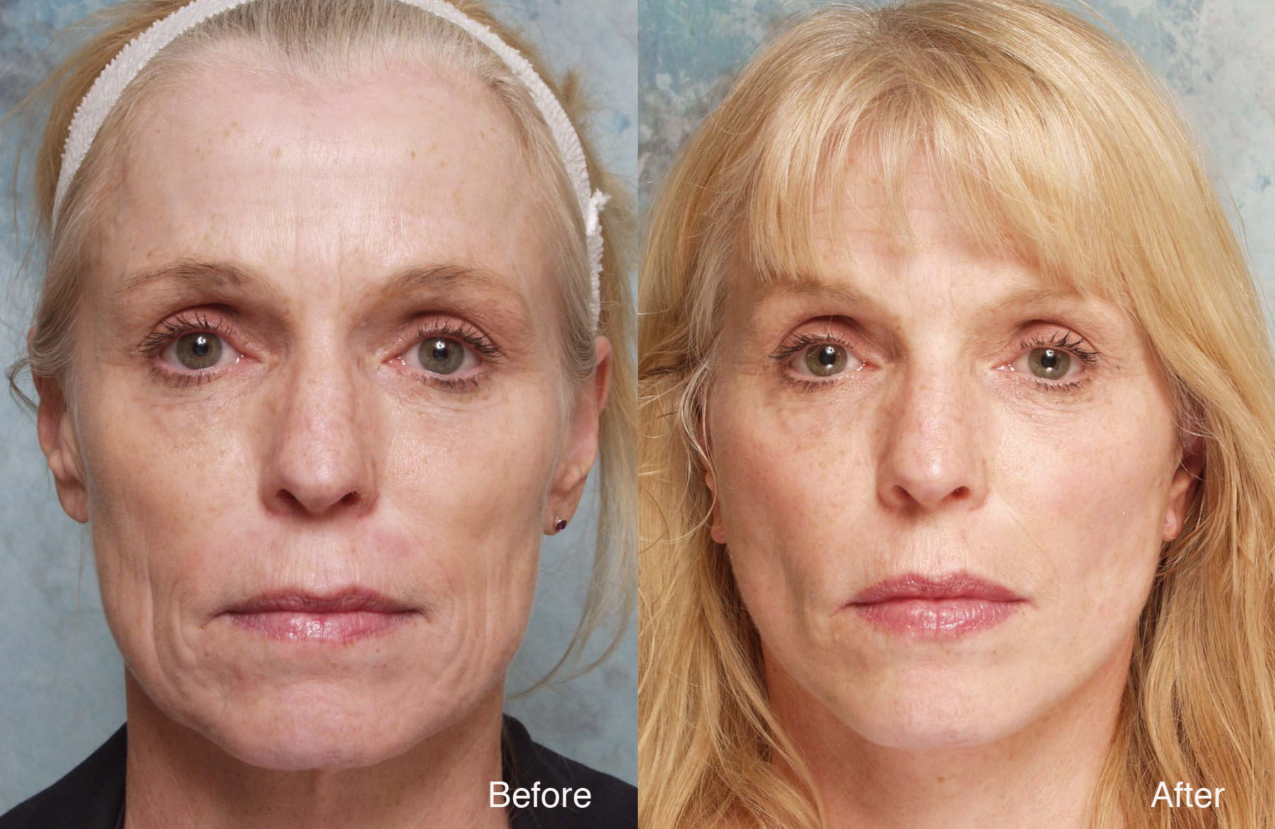 Procedure: Facial Plastic Surgery