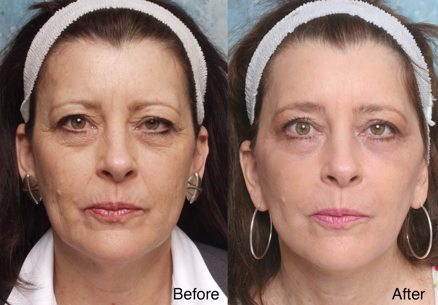 Procedure: Cosmetic Facial Surgery