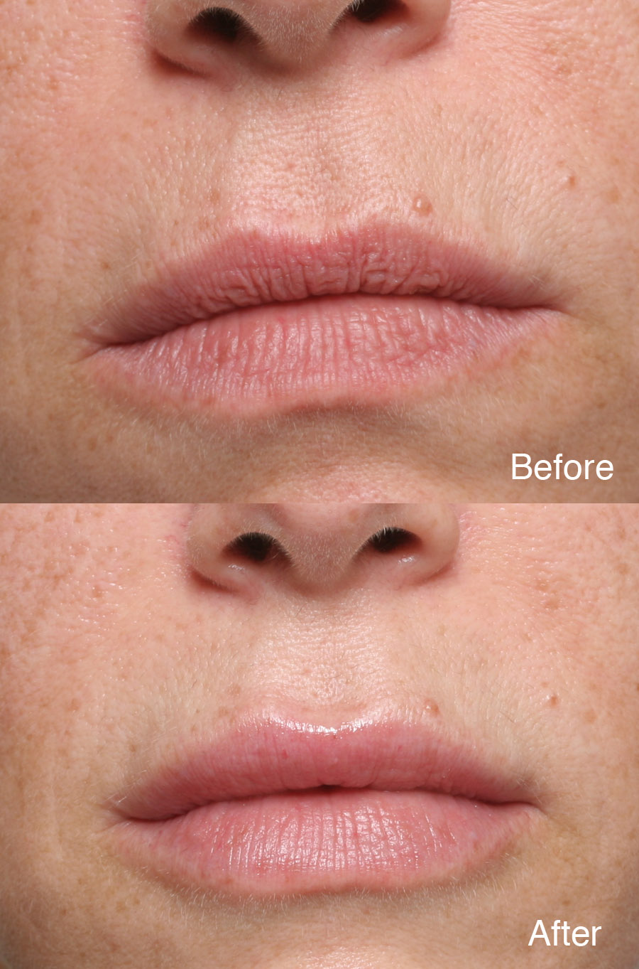 Procedure: Lip Filler
