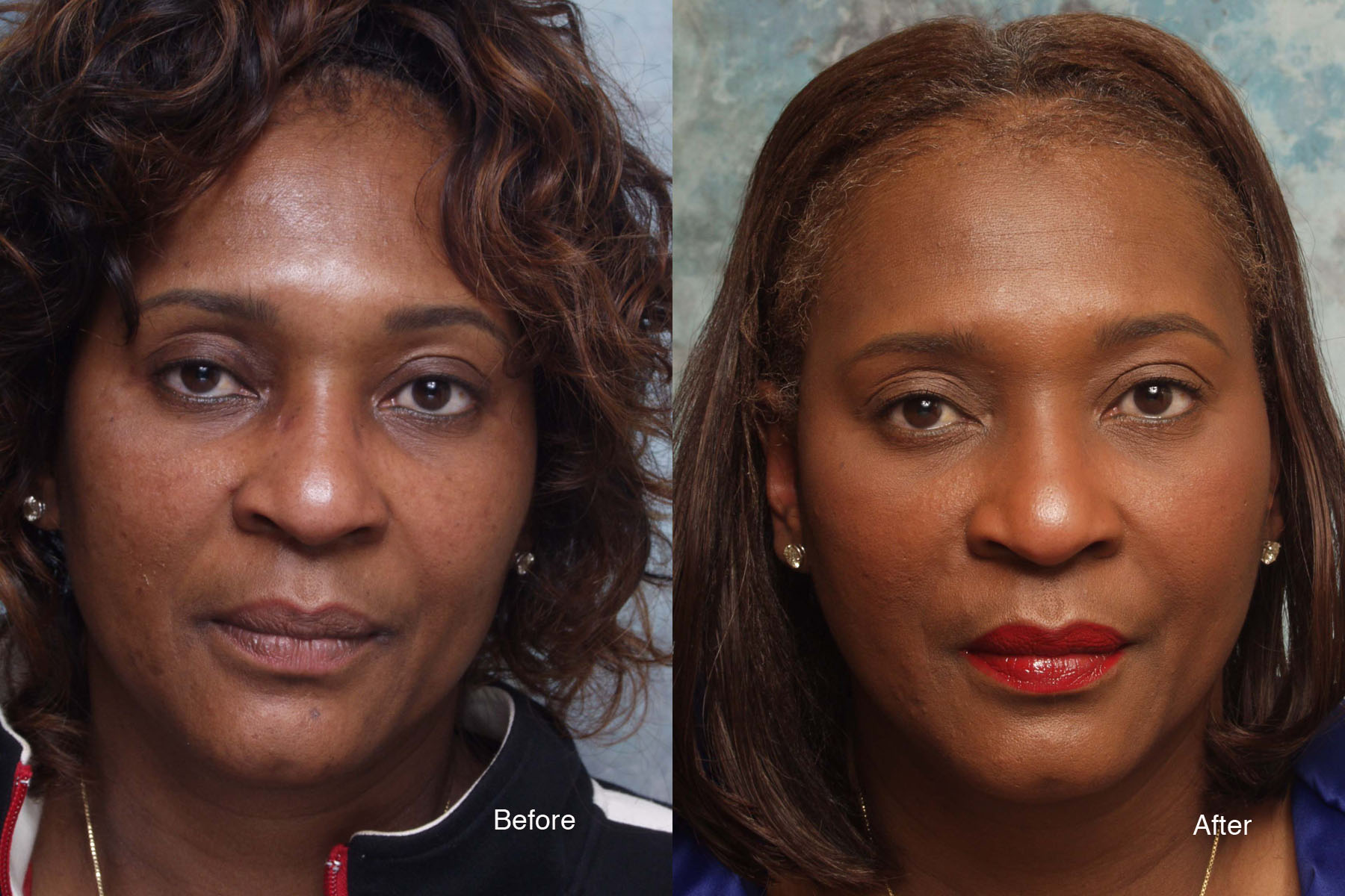 Procedure: Cosmetic Eyelid Surgery, Filler, and Microdroplet Lift® BOTOX®