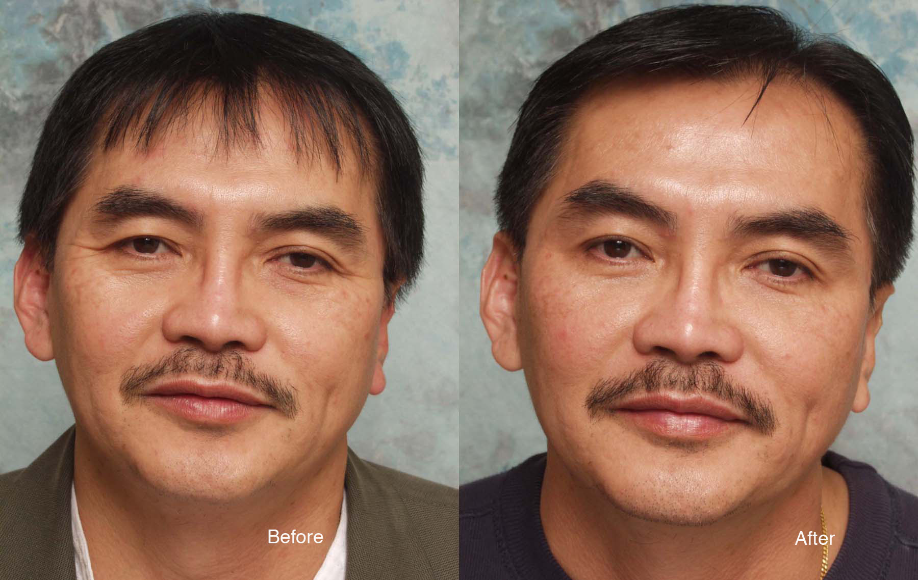 Procedure: Microdroplet Lift® BOTOX® and Undereye Deepfill™ Restylane®