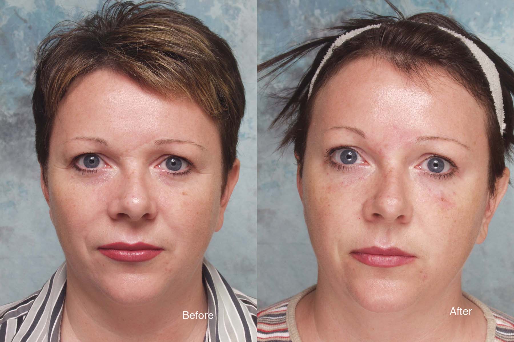Procedure: Microdroplet Lift® BOTOX® and Undereye Deepfill™ Restylane®