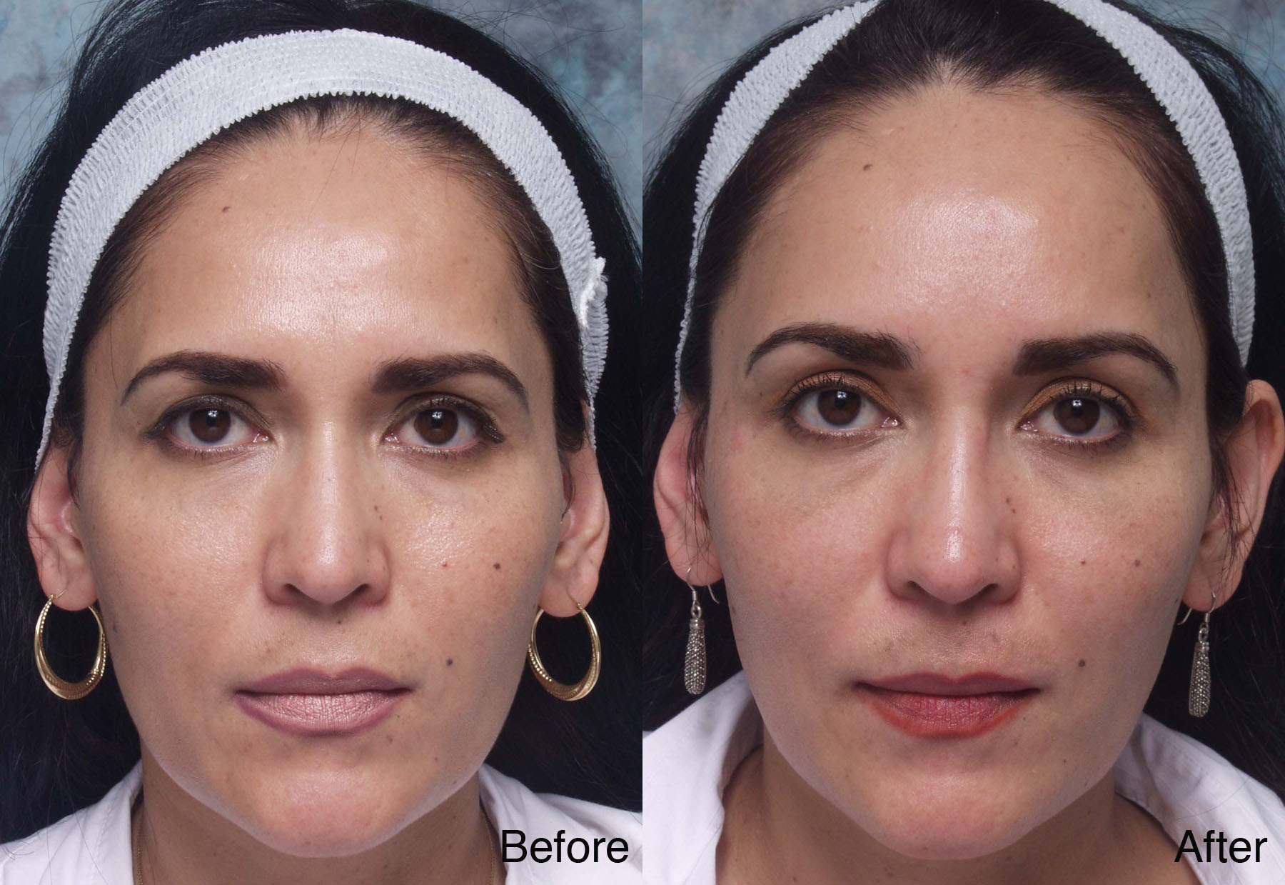 Procedure: Undereye Restylane®