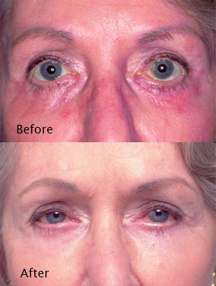 Procedure: Fixing Botched Lower Eyelids Case 1