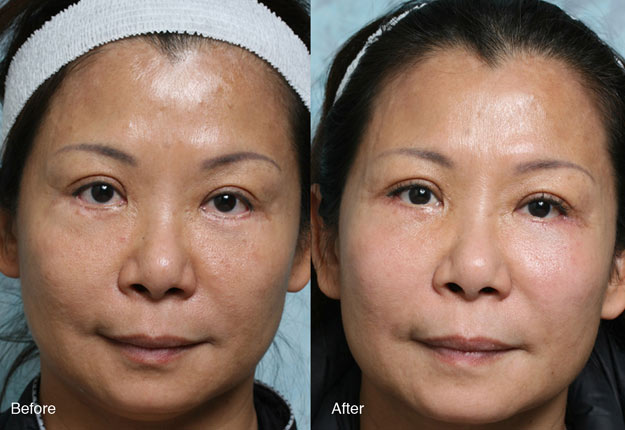 Procedure: Fixing Botched Lower Eyelids Case 4