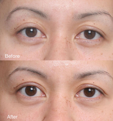 Procedure: Fixing Botched Upper Eyelids Case 4