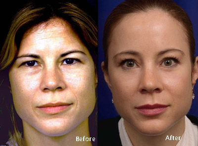 Procedure: Forehead Lift, Eyelid Surgery, and Chemical Peel