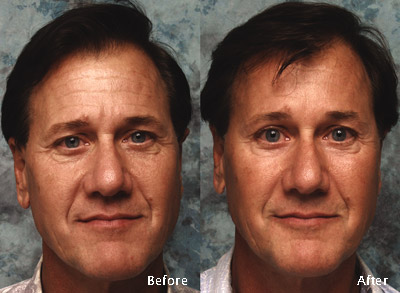 Procedure: Forehead Cosmetic Surgery