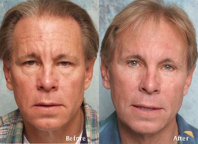 Procedure: Facial Rejuvenation