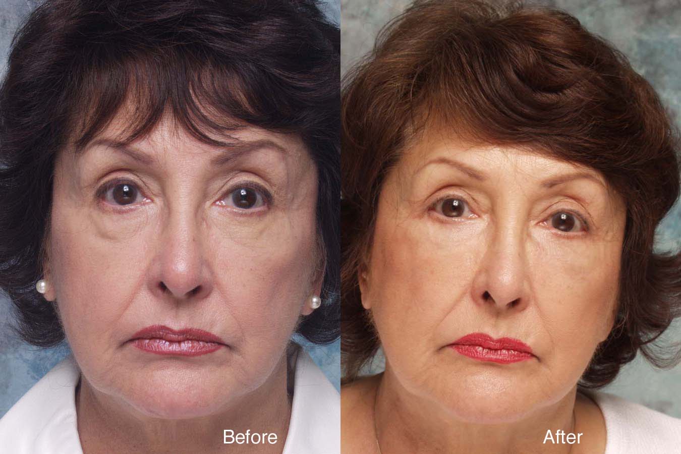 Procedure: Midface Surgery