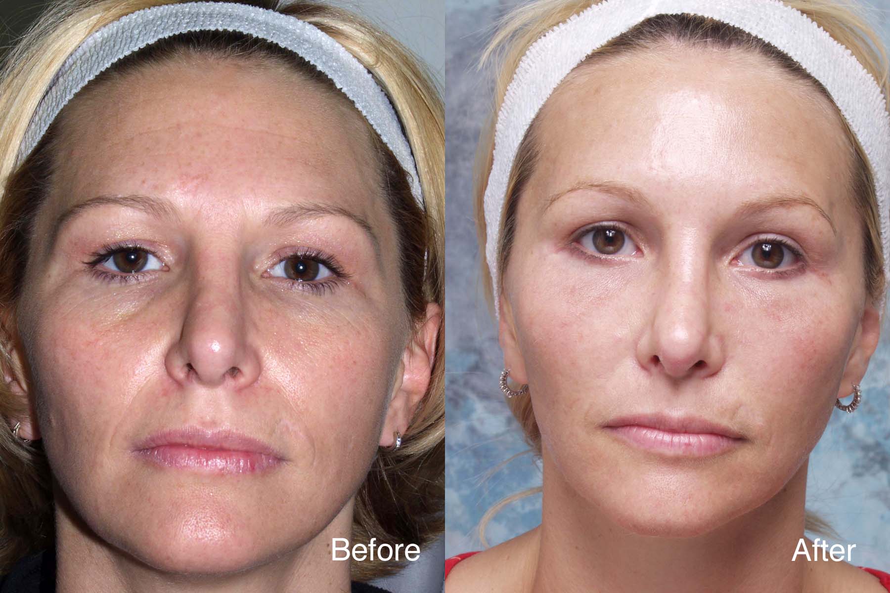 Procedure: Midface & Forehead Lift
