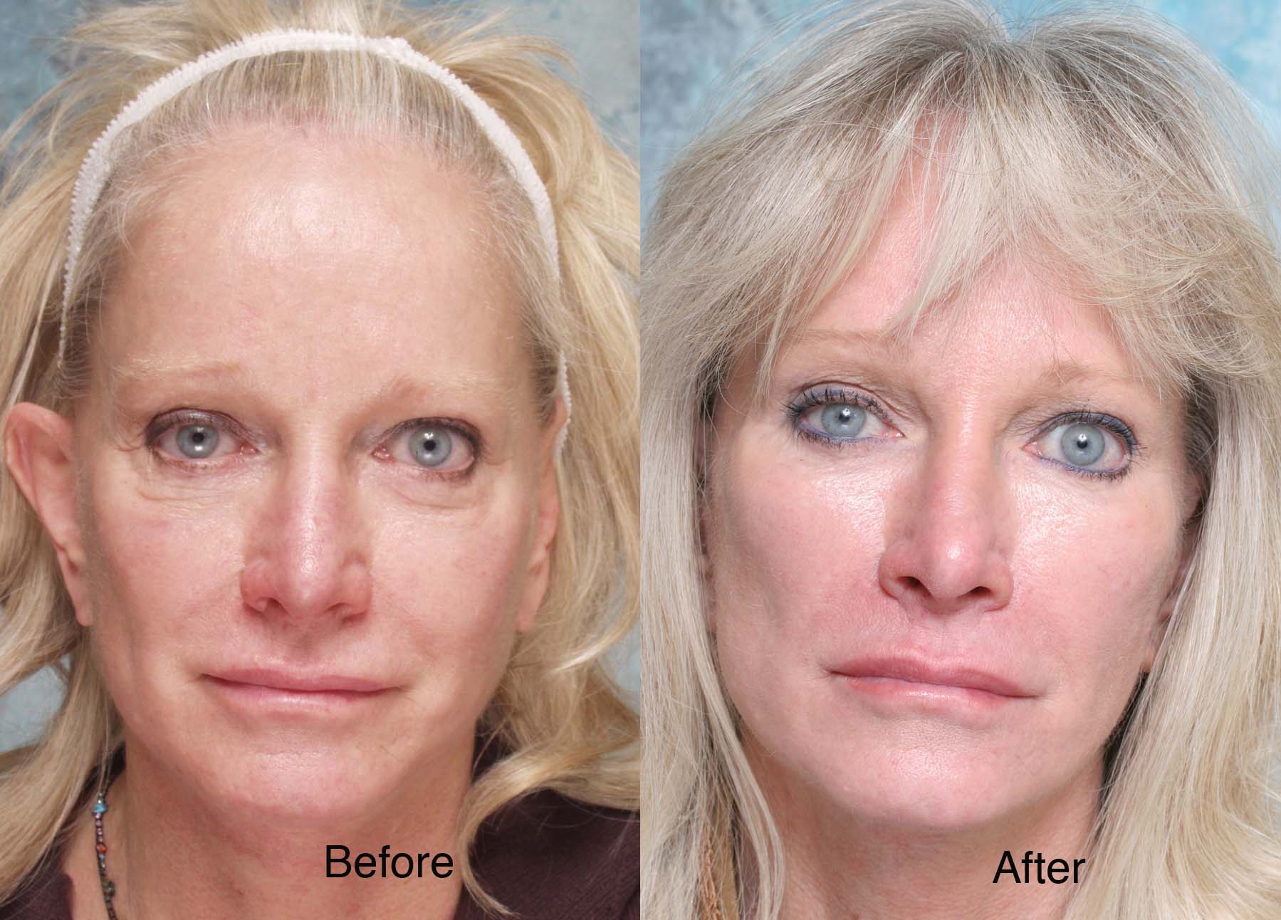 Procedure: Midface Surgery